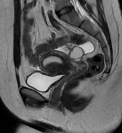 Transient physiologic uterine contraction on MRI | Radiology Case ...