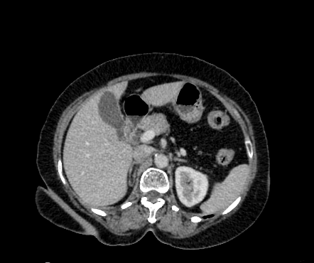 Dorsal agenesis of pancreas | Radiology Case | Radiopaedia.org