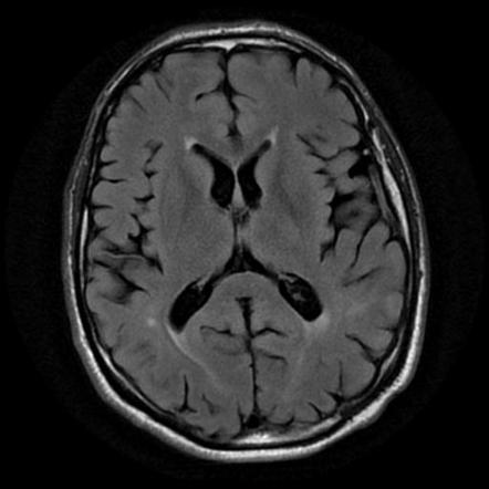 Cerebral amyloid angiopathy | Radiology Case | Radiopaedia.org