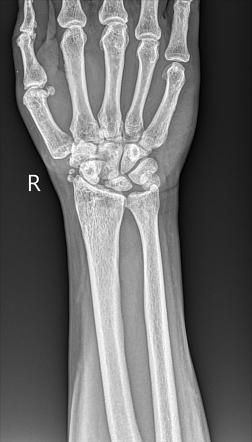 Scaphoid nonunion advanced collapse | Radiology Case | Radiopaedia.org