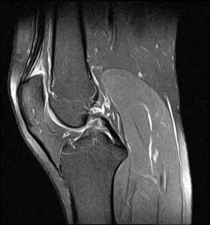 Quadriceps Fat Pad Impingement Syndrome 