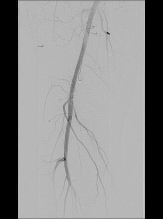 Normal popliteal angiogram | Radiology Case | Radiopaedia.org