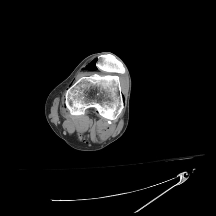 Pneumolipohemarthrosis | Radiology Case | Radiopaedia.org