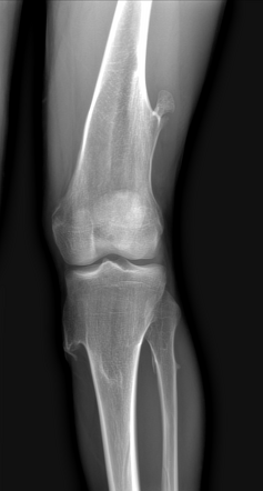 Hereditary multiple exostoses (osteochondromatosis) | Radiology Case ...