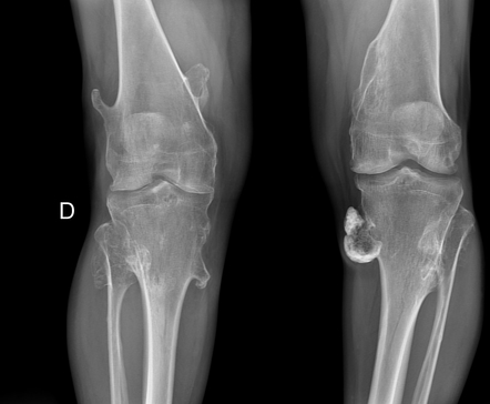 Hereditary multiple exostoses (1-year follow-up) | Radiology Case ...