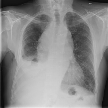 Marginal zone lymphoma | Radiology Case | Radiopaedia.org