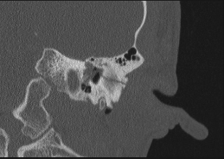 Temporal Bone Fracture Radiology Reference Article Radiopaedia Org