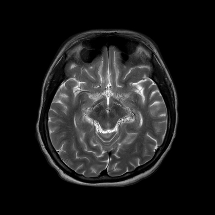 Moyamoya disease | Radiology Case | Radiopaedia.org