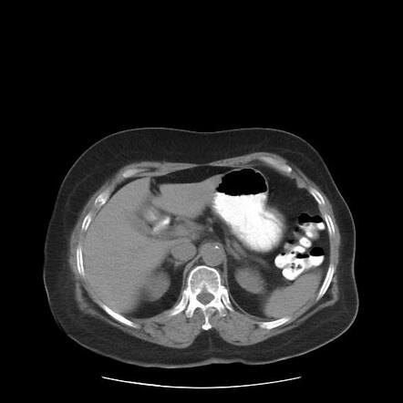 Dorsal pancreatic agenesis | Radiology Case | Radiopaedia.org