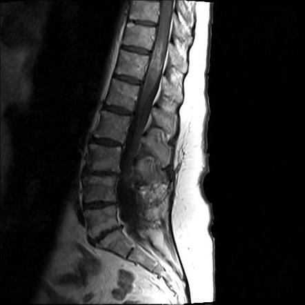 Transverse myelitis | Image | Radiopaedia.org