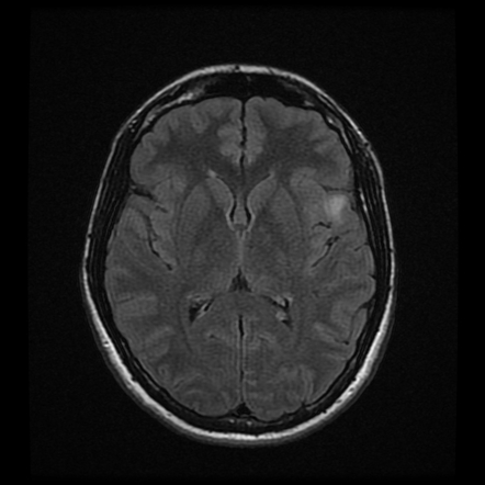 Oligodendroglioma | Radiology Case | Radiopaedia.org