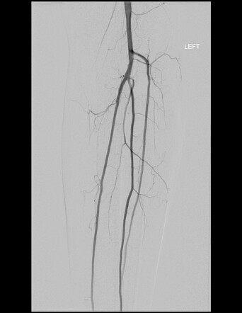 Normal leg angiogram | Radiology Case | Radiopaedia.org