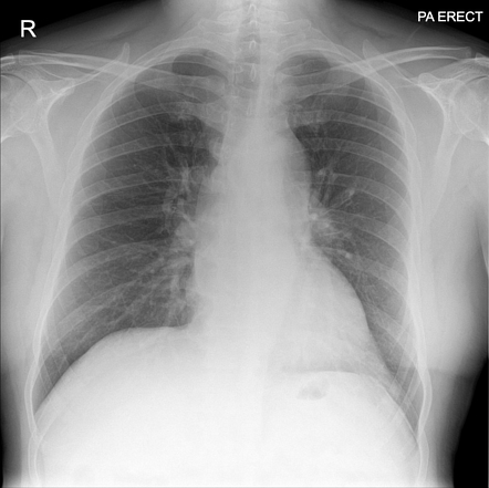 Stanford type A aortic dissection with aortopulmonary sheath haematoma ...