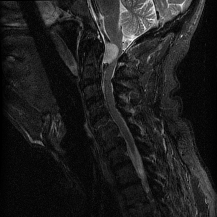 Craniocervical junction meningioma | Radiology Case | Radiopaedia.org