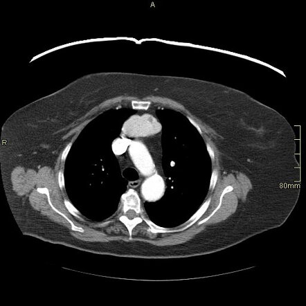 Substernal goiter and ectopic thyroid | Radiology Case | Radiopaedia.org