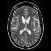 Huntington Disease Radiology Reference Article Radiopaedia Org