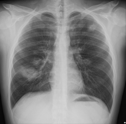 Granulomatosis with polyangiitis | Radiology Case | Radiopaedia.org