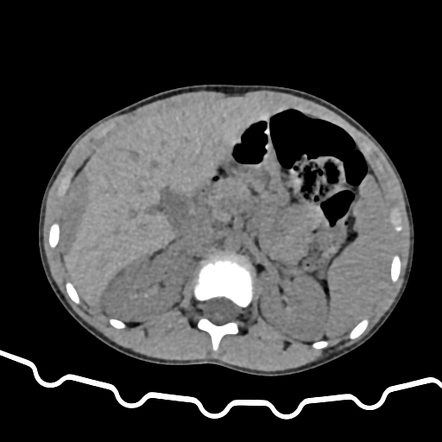 Paediatric liver injury - AAST grade V | Radiology Case | Radiopaedia.org