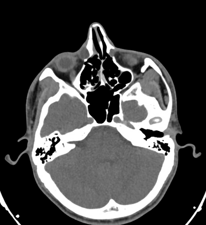 Nasolacrimal duct obstruction | Radiology Case | Radiopaedia.org