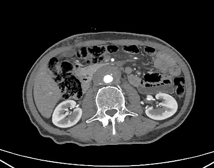 Retroperitoneal fibrosis | Radiology Case | Radiopaedia.org