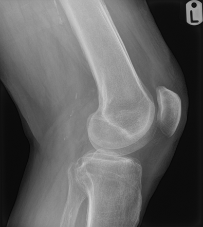 Hypertrophic osteoarthropathy | Radiology Case | Radiopaedia.org