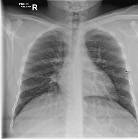 Normal prone CXR | Radiology Case | Radiopaedia.org