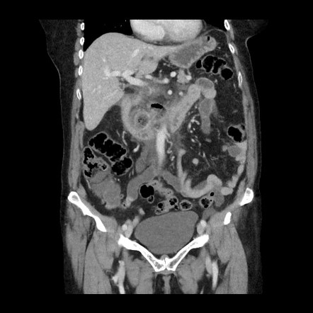 Acute duodenal diverticulitis mimicking pancreatitis | Radiology Case ...