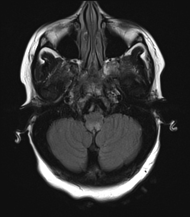 Area postrema syndrome in neuromyelitis optica spectrum disorder (NMOSD ...