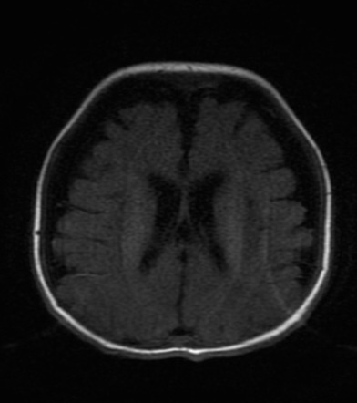 Glutaric Aciduria Type 1 Radiology Case Radiopaedia Org   Cfa2d6c25f2bcb9b71d95026b78346 Gallery 