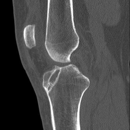 ACL graft tear due to tunnel malpositioning | Radiology Case ...