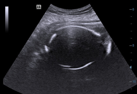 Intrauterine fetal demise | Radiology Case | Radiopaedia.org