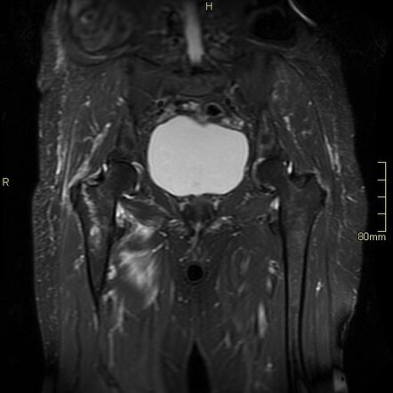 Intertrochanteric femur fracture - spectral CT | Radiology Case ...