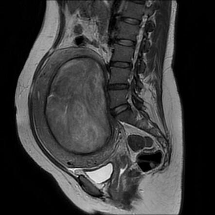 Large uterine leiomyoma with red degeneration | Radiology Case ...