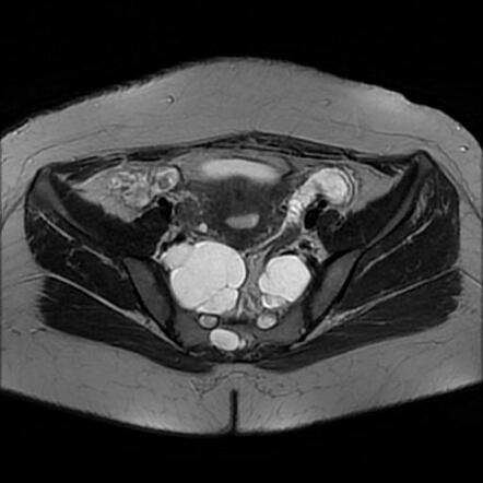 Giant Tarlov cysts | Radiology Case | Radiopaedia.org