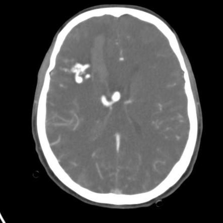 Brain arteriovenous malformation | Radiology Reference Article ...