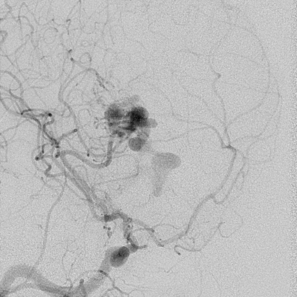 Cerebral Arteriovenous Malformation With Hemorrhage Image 9717