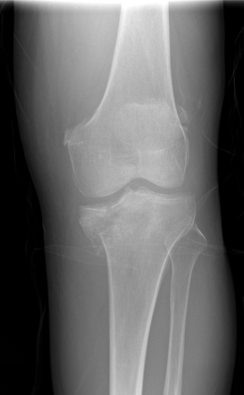 Neuropathic knee with calcified synovium | Radiology Case | Radiopaedia.org