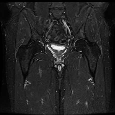 Rectus-adductor aponeurosis avulsion and superior cleft sign ...