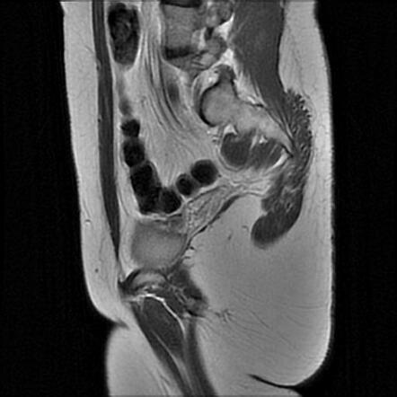 Mayer-Rokitansky-Küster-Hauser syndrome with rudimentary uterine horns ...