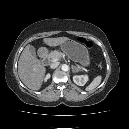 Dorsal pancreatic agenesis | Radiology Case | Radiopaedia.org