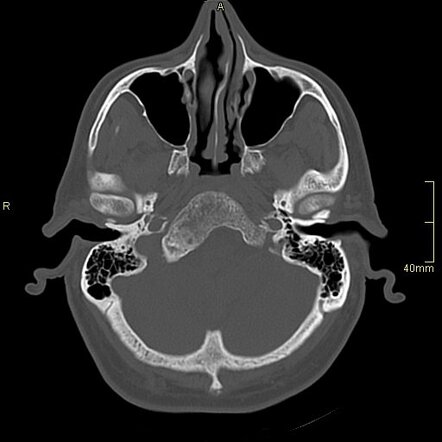 Fibrous dysplasia of skull base - clivus | Radiology Case | Radiopaedia.org