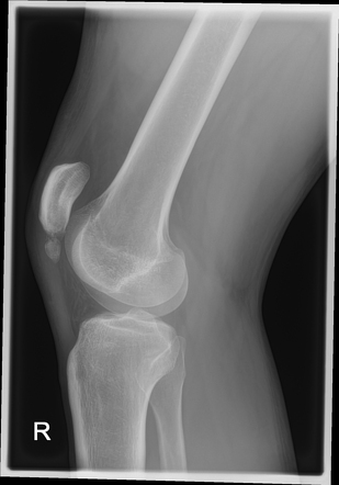 Symptomatic bipartite patella type 1 | Radiology Case | Radiopaedia.org