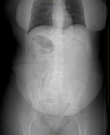 Post gastric bypass transmesenteric internal hernia | Radiology Case ...