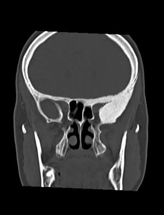 Meningioma (sphenoid wing - en plaque) | Radiology Case | Radiopaedia.org