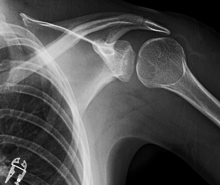 Light bulb sign (posterior shoulder dislocation) | Radiology Case