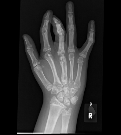 Melorheostosis | Radiology Case | Radiopaedia.org