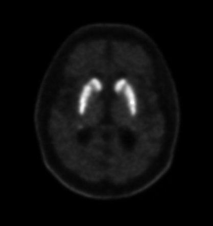 Normal [18F]FP-CIT scan (DAT scan) | Radiology Case | Radiopaedia.org