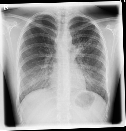 Bronchopneumonia | Radiology Case | Radiopaedia.org