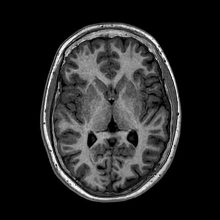 Hypothalamic hamartoma | Radiology Case | Radiopaedia.org