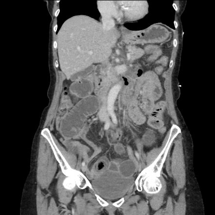 Primary true enterolithiasis causing acute small bowel obstruction ...